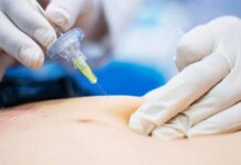 Carboxiterapia: O que é? Para que serve? Conheça um pouco mais sobre a técnica